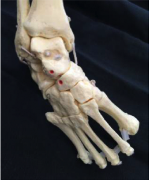 File:Clubfoot3.png