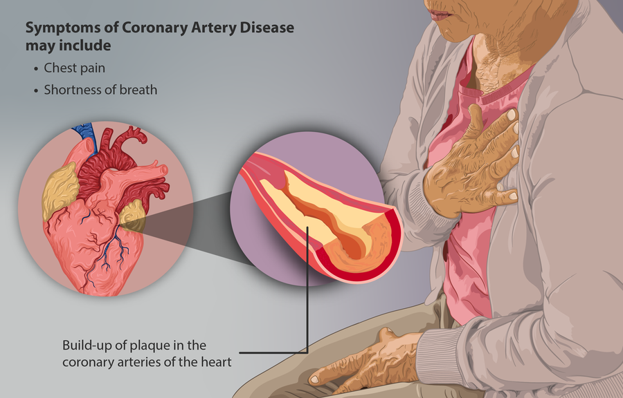 Coronary Artery Disease (CAD) Physiopedia