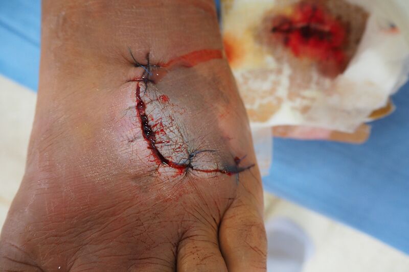 File:Non healing sx wound 1.jpeg