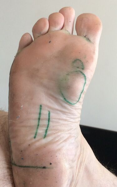 File:Plantar fibromatosis foot.jpeg