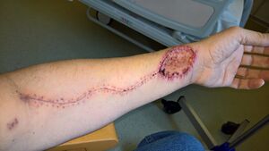 Left forearm after taking of a forearm flap.jpg
