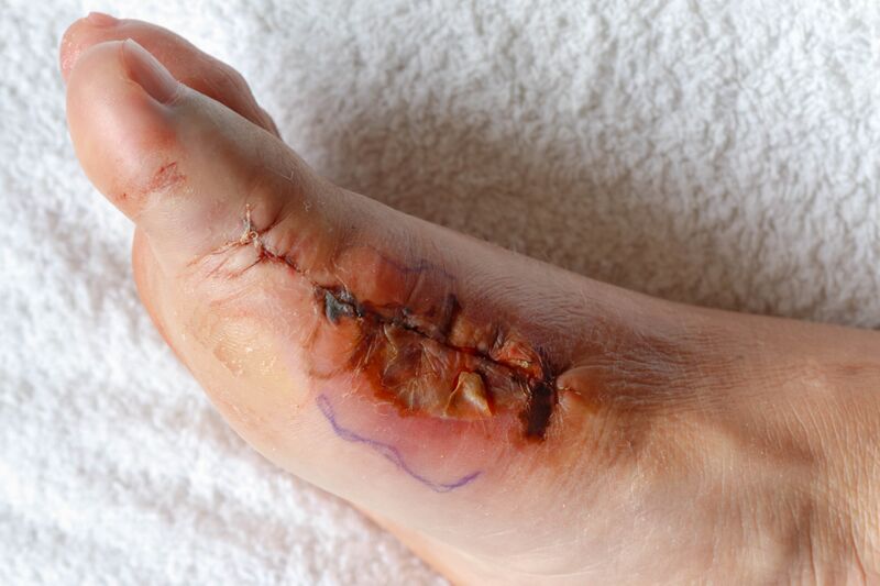 File:Non healing sx wound.jpeg