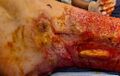Subcutaneous burn wound with exposed tendon