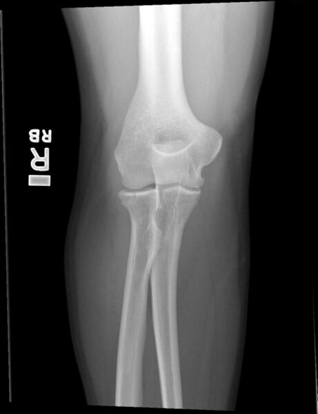 File:Type 1 Fracture.jpg