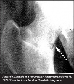 Femoral stress fracture compression.jpg