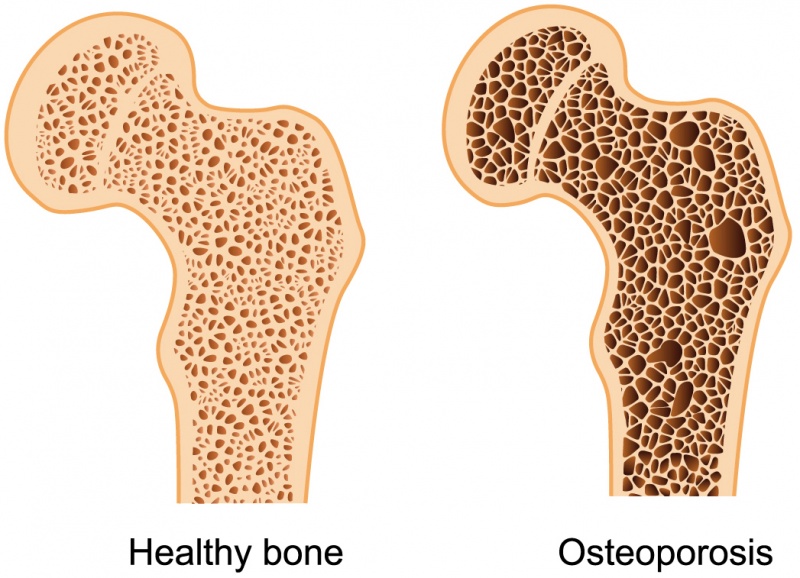 File:Osteoporosis.jpg