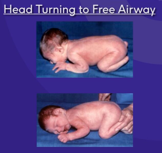 File:Infant head turn.jpg