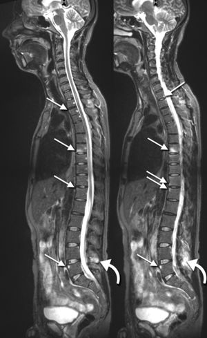 Thoracic Disc Syndrome Physiopedia