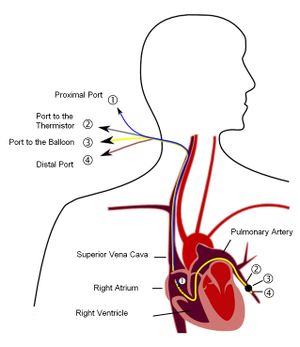 Pulmonary artery catheter english.jpeg