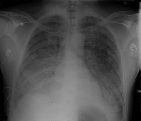 450px ARDS chest
