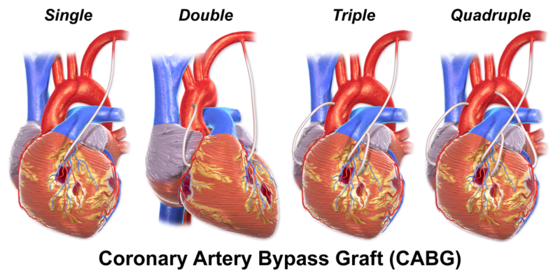 File:CABG All.png