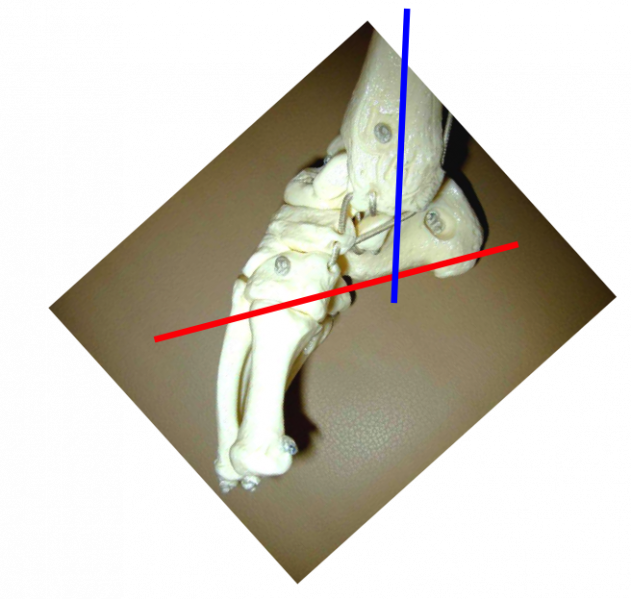 File:Clubfoot10.png