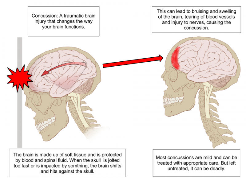 File:Concussion Anatomy.png