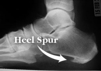 Calcaneal Spurs Physiopedia