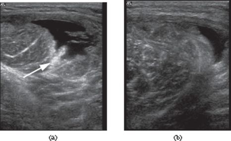 Contusion ultrasound imaging.jpg