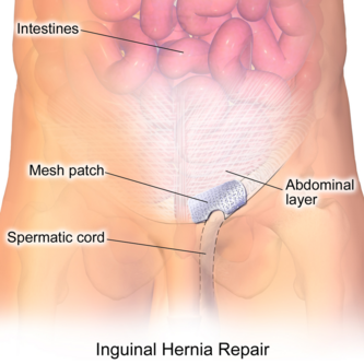 Mens Scrotal Groin Hernia Support For Functional Health Care And