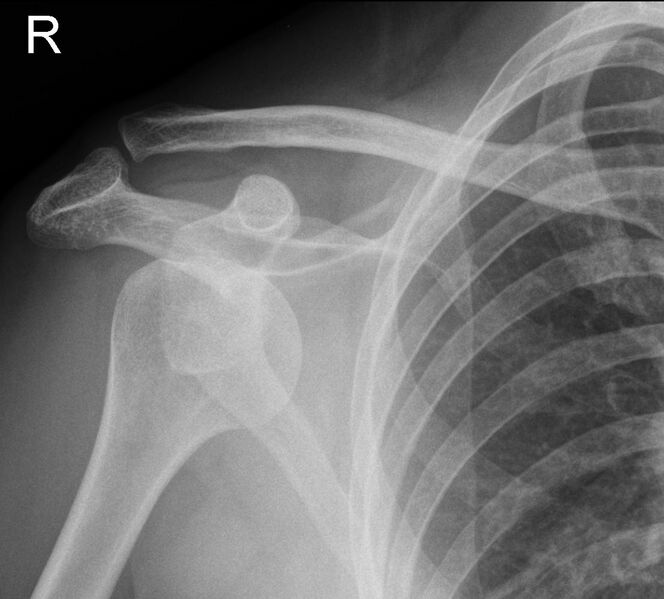 File:Anterior-shoulder-dislocation-1.jpeg