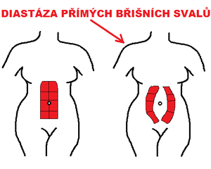Diastasis recti pregnancy.png