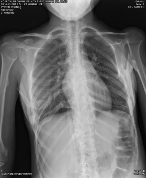 File:Ossification lower ribs.jpg
