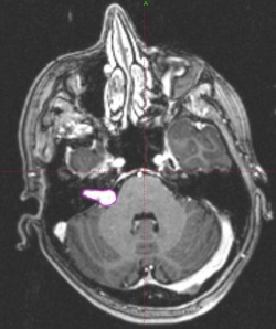Acoustic Neuroma outlined in pink