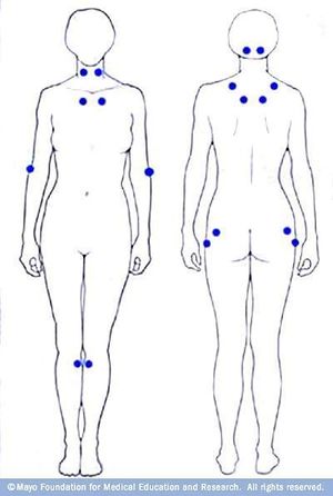 Fibromyalgia Pain Chart.JPG