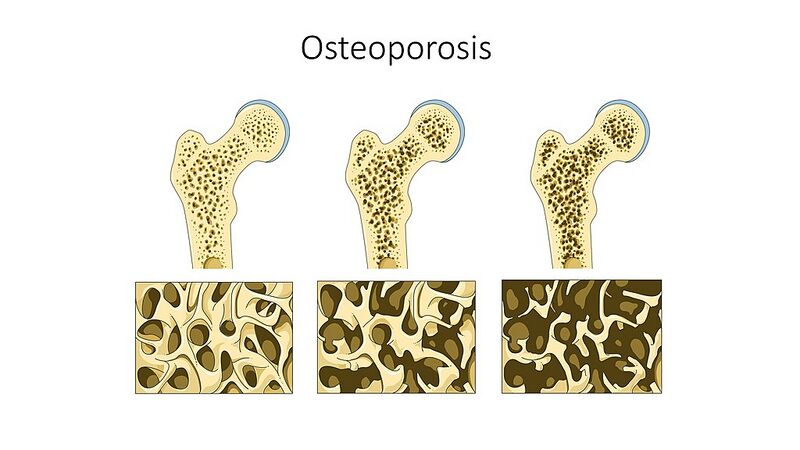 File:Osteoporosis changes.jpeg