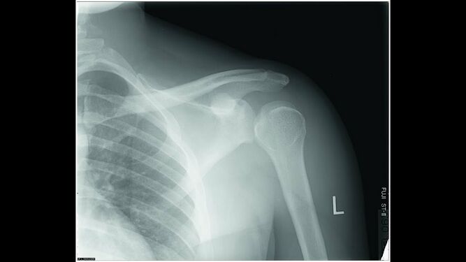Figure. Radiographic image of Post stroke shoulder dislocation[2].