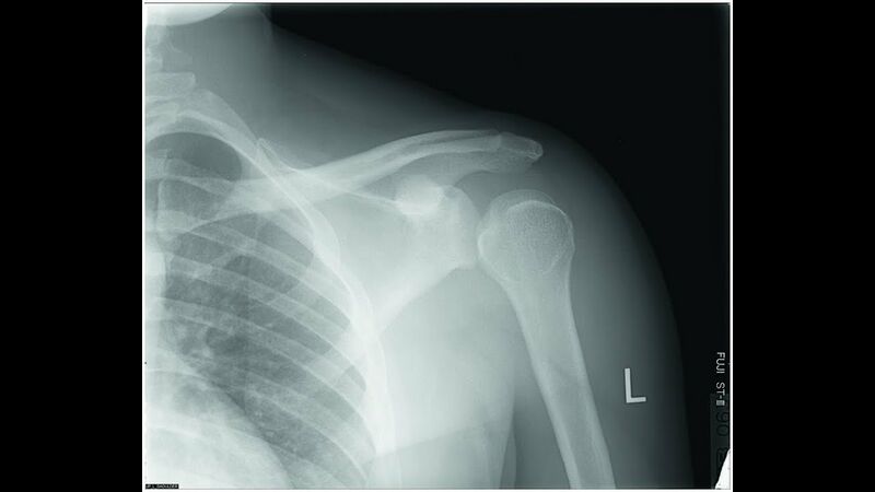 File:Post stroke shoulder dislocation.jpg