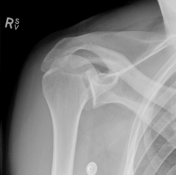 File:Posterior-shoulder-dislocation-with-reverse-hill-sachs-and-reverse-bankart-lesions.jpeg