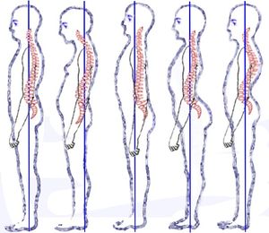 Posture types (vertebral column).jpg