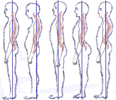 Why Lifting With A Straighter Spine Doesn't Reduce Your Risk Of Back Pain –  The Sports Physio