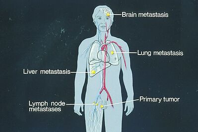 Sites of potential metastases illustration.jpeg