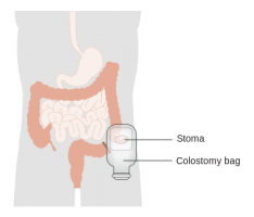 Colostomy.png