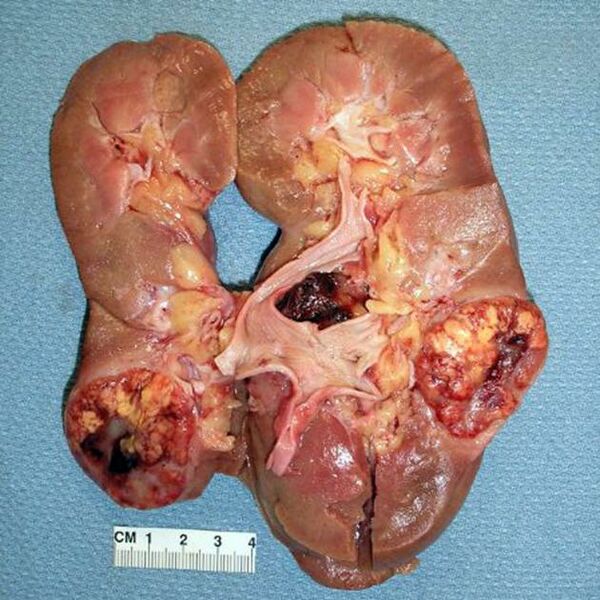 File:Renal cell carcinoma.jpg
