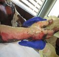 Pseudo-eschar formation over burn wound on hand
