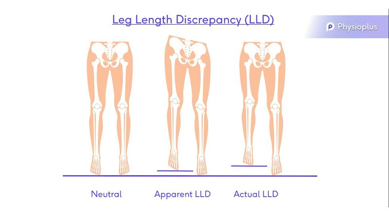 Leg Length.jpg