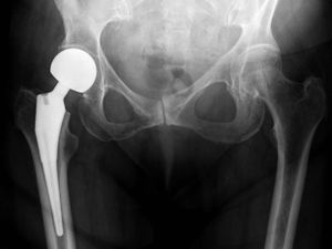 Hemiarthroplasty hip.jpg