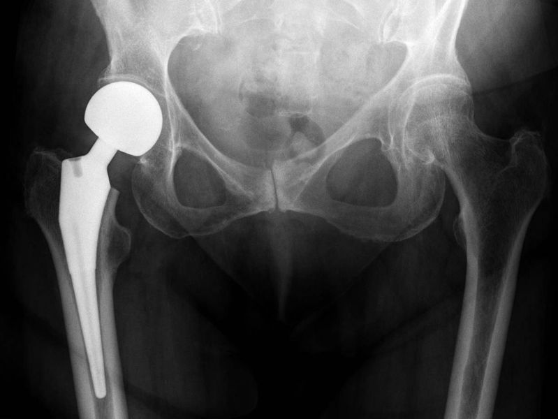 File:Hemiarthroplasty hip.jpg