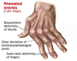 rheumatoid arthritis presentation