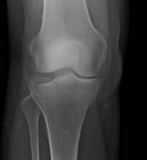 Fracture running plateau stress tibial Medial tibial