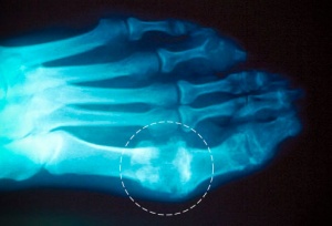 X-ray gout.jpg