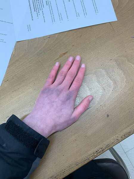 File:Hand of person with POTS dysautonomia.jpeg