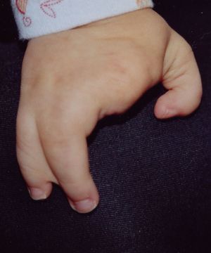 Image showing ectrodactyly or cleft hand