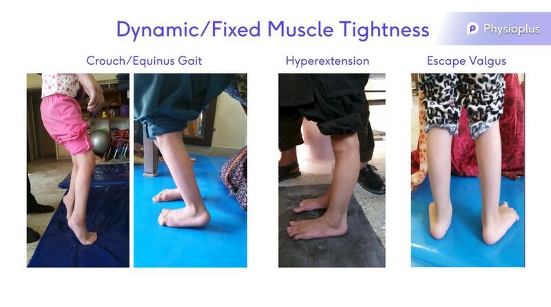File:Dynamic vs Fixed Muscle Tightness.jpg