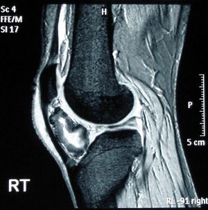 osteochondroma knee mri arthritis rheumatoid crepitus imaging resonance magnetic accelerated ct exostosis wikipedia figure sagittal scans via