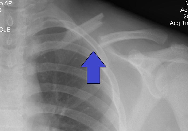 File:Clavicle Fracture Left.jpg