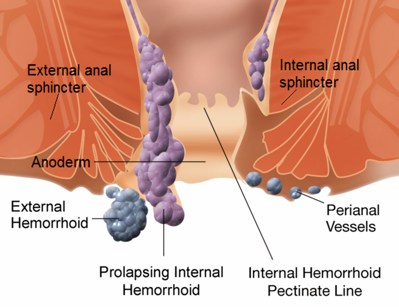 File:Internal and external hemorrhoids.png