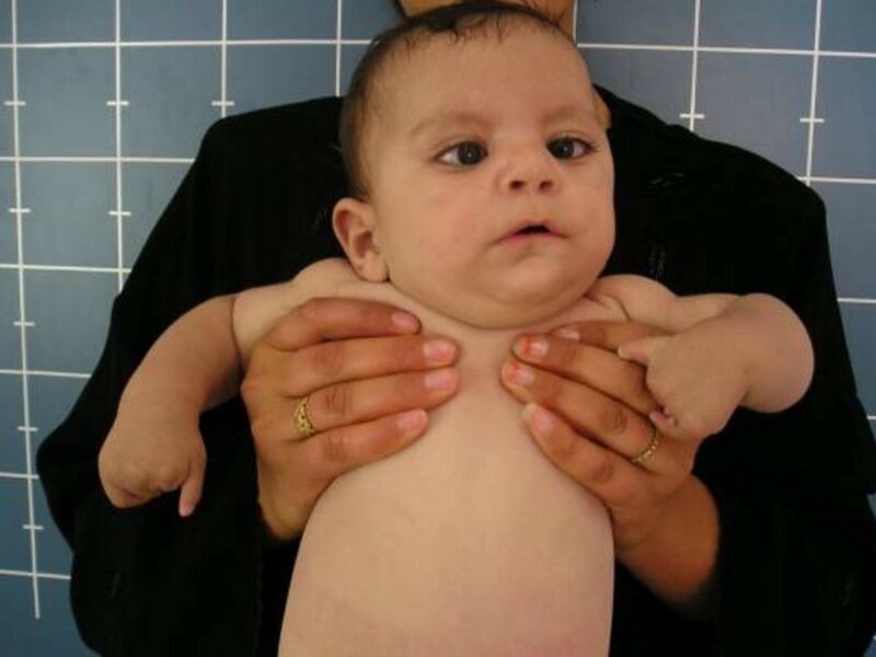 File:Infant with Möbius syndrome.jpg