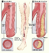 Peripheral Arterial Disease.gif