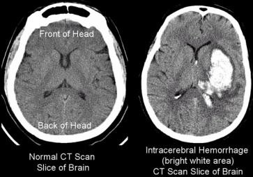 CT-Intracerebral-Hemorrhage.jpg